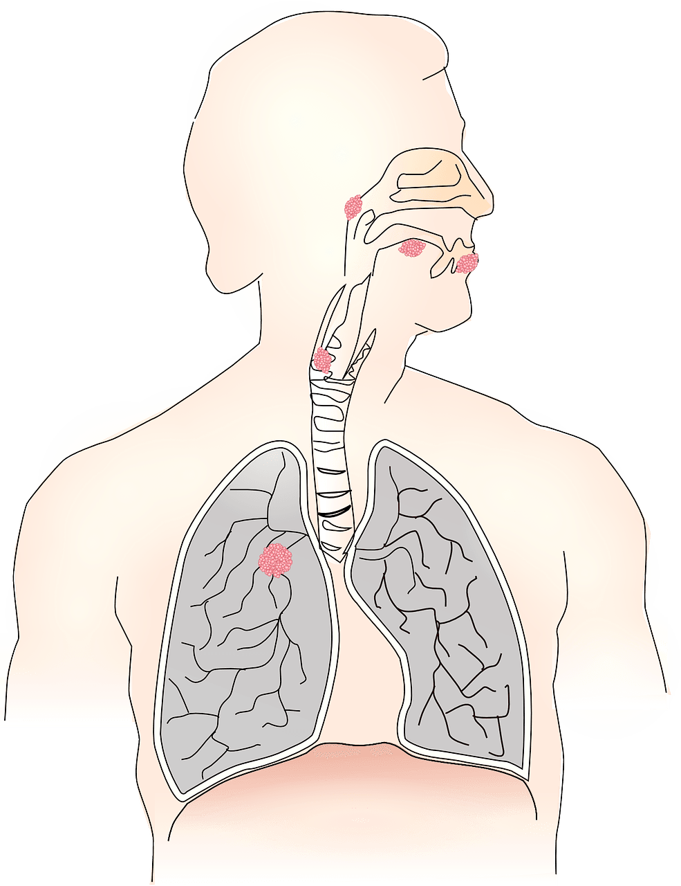Can I take steroids while on immunotherapy?