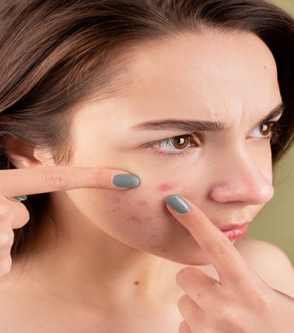 How common is acne in the UK