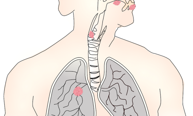 Can I take steroids while on immunotherapy?