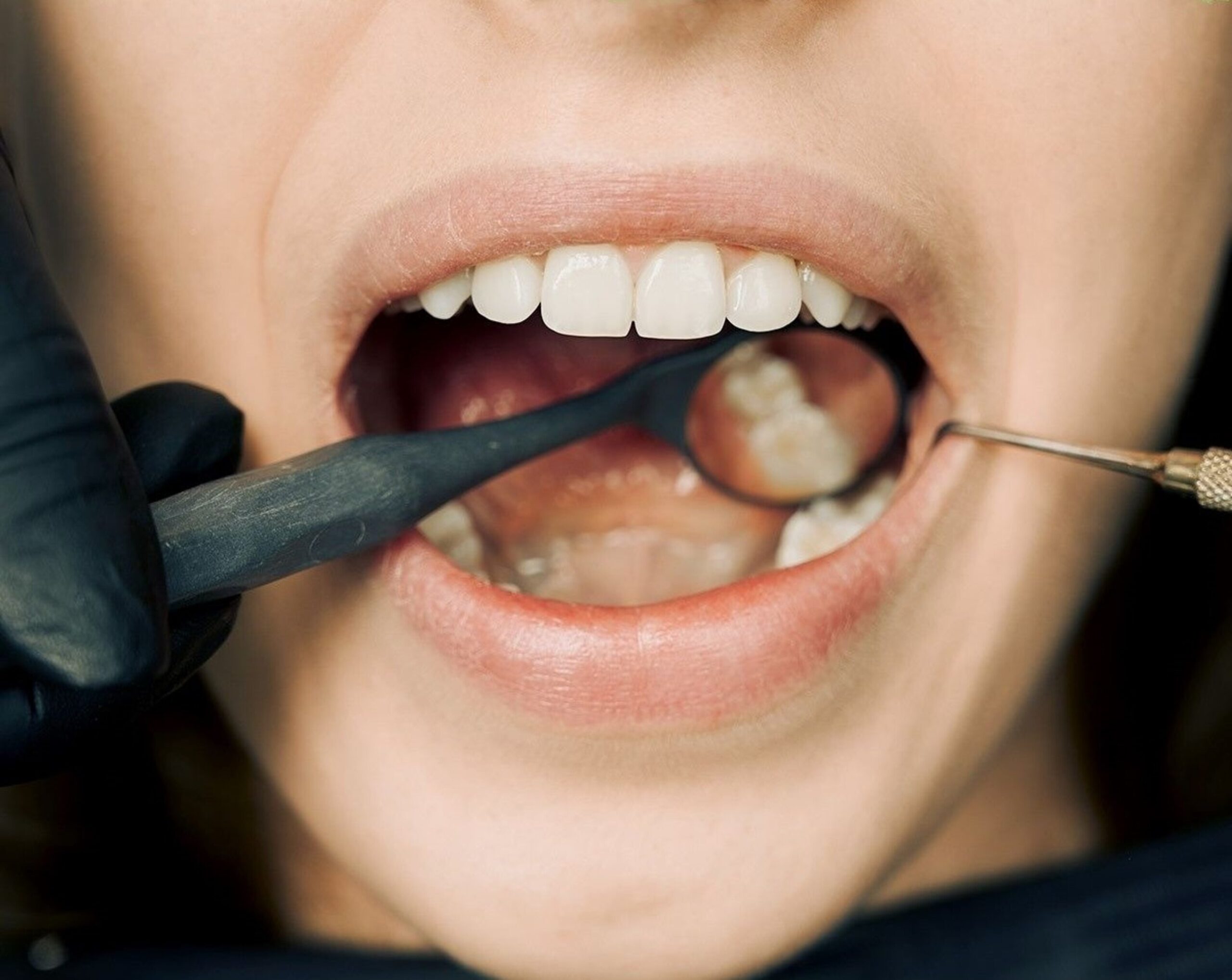 The Impact of Steroids on Tooth Infections