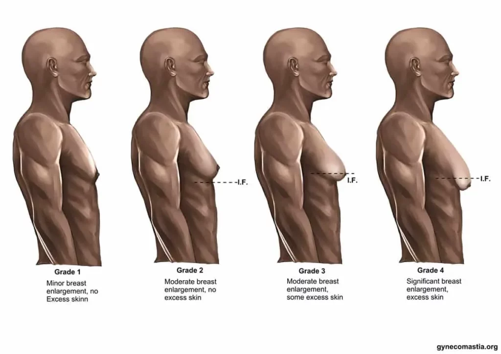 Gynecomastia diagram stage 1-4