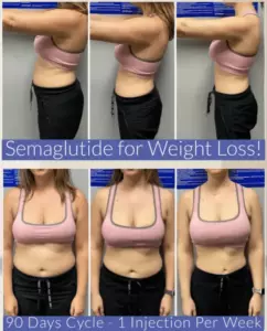 Semaglutide weight loss results - Women body before and after 90 days 1 injection per week